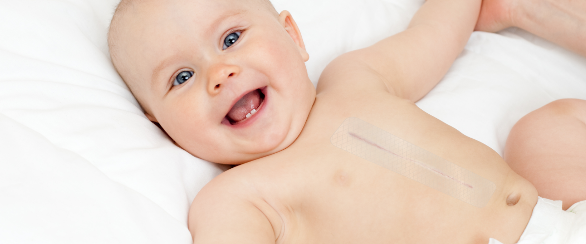 An incision scar that has healed on a baby. The baby had received pediatric congenital heart surgery and did not have a surgical site infection.