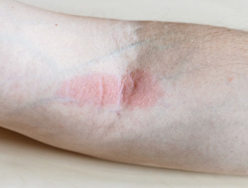 A medical adhesive related skin injury, aka MARSI, on a patient's arm