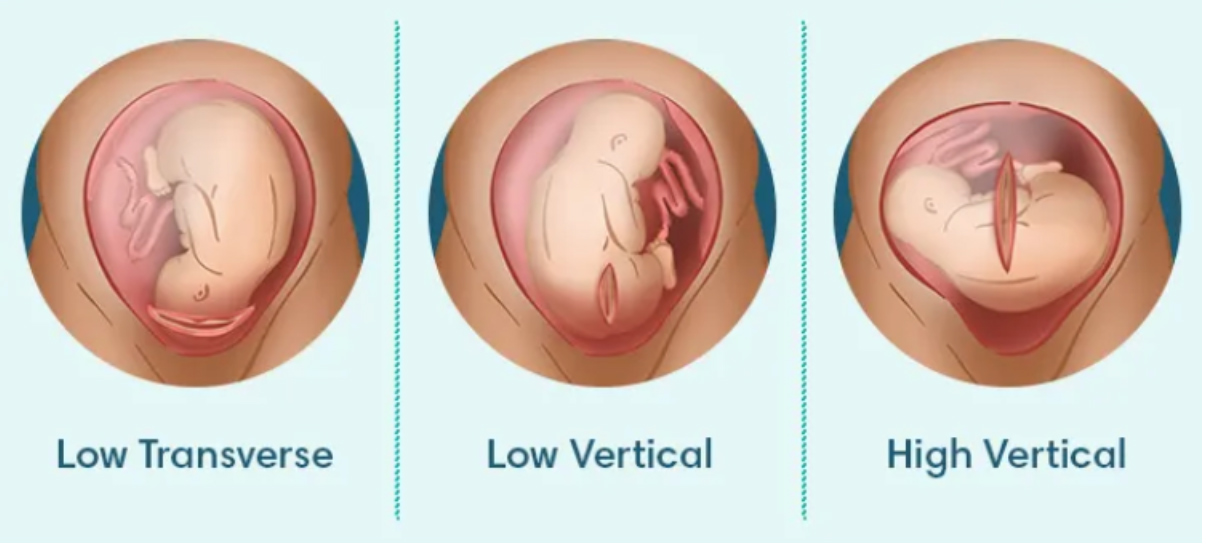 3 ways to make a c-section incision - Low Transverse, Low Vertical, High Vertical. Image Source: Pampers.