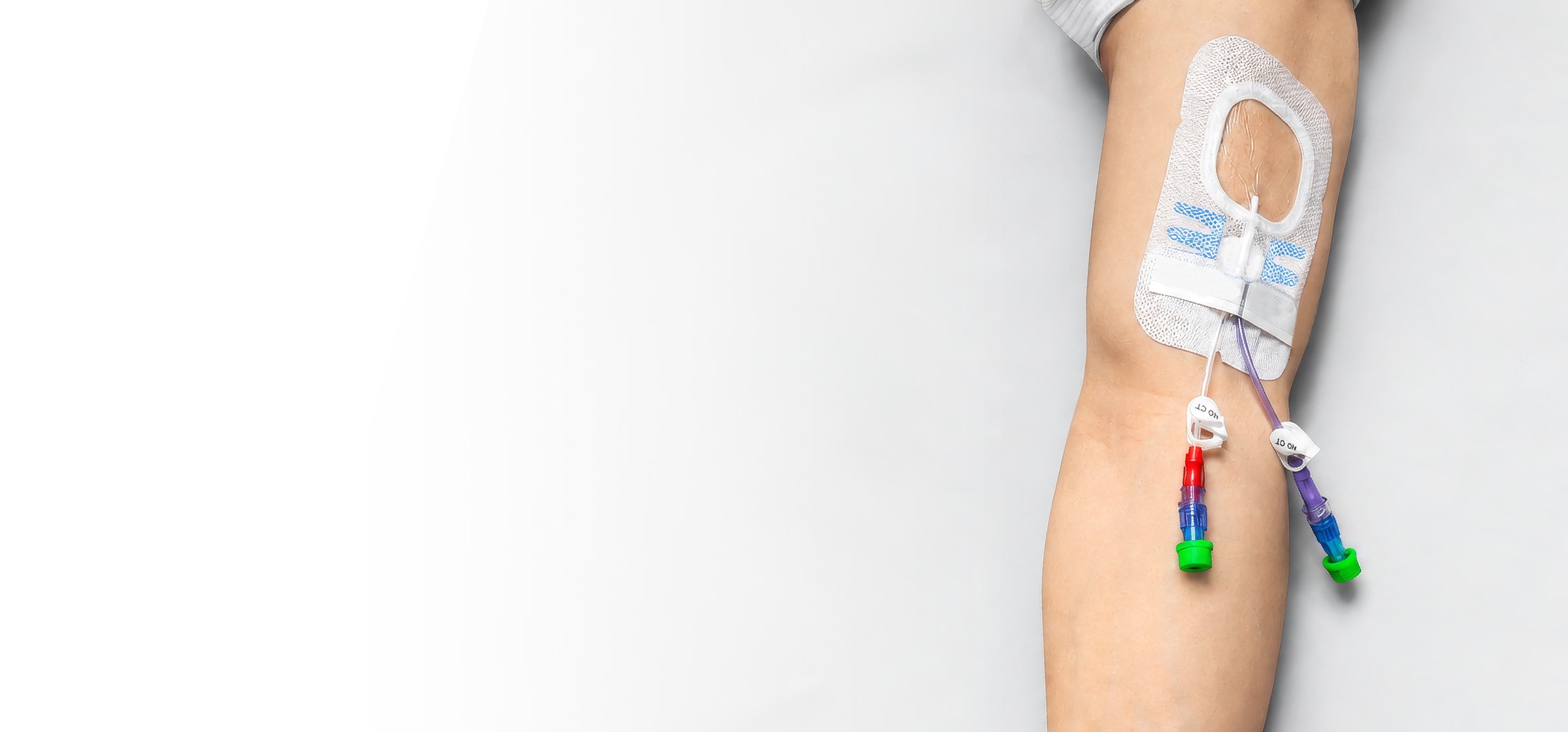 Patient arm with an IV dressing and line connections, without added barriers