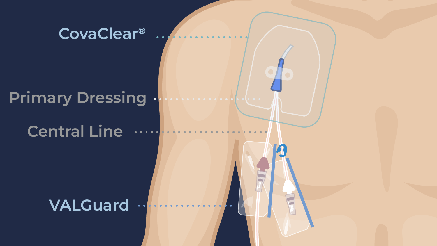 Diagram of a central line on the upper arm: CovaClear covers the primary dressing at the insertion site and VALGuard covers the line connections